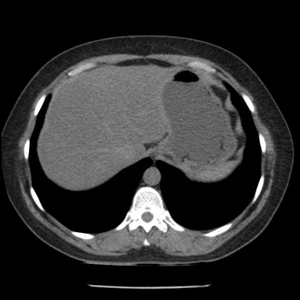 Adrenal myelolipoma (Radiopaedia 43401-46759 Axial non-contrast 13).jpg