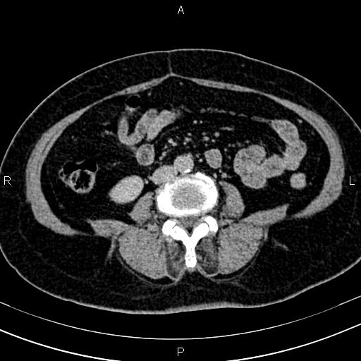 Adrenal myelolipoma (Radiopaedia 82742-96986 Axial renal excretory phase 91).jpg