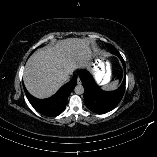 Adrenal myelolipoma (Radiopaedia 84319-99617 Axial With oral contrast 29).jpg