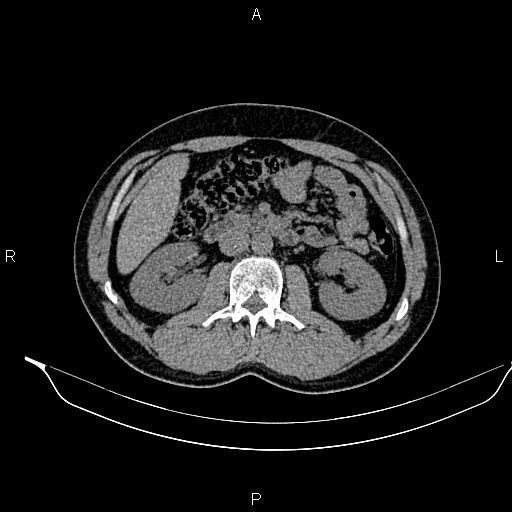 File:Adrenal myelolipoma (Radiopaedia 87794-104246 Axial non-contrast 47).jpg