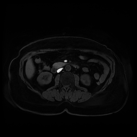 Adrenal myelolipoma - MRI (Radiopaedia 83249-97646 Axial T1 fat sat 52).jpg