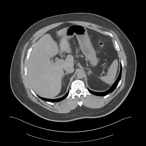File:Adrenal vein sampling and adrenal nodular hyperplasia - Conn syndrome (Radiopaedia 30561-31337 Axial non-contrast 18).jpg