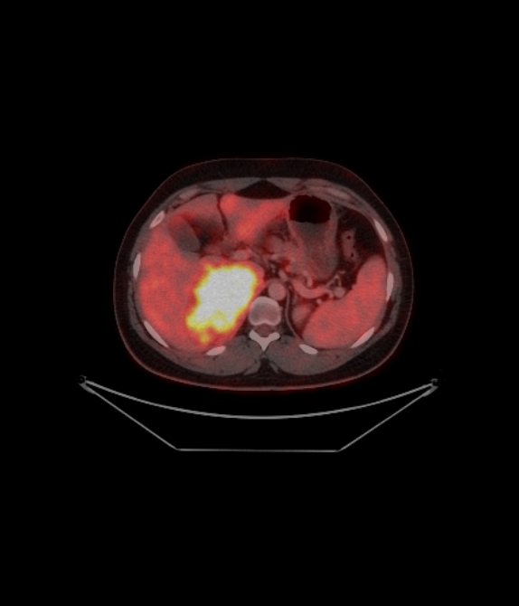 Adrenocortical carcinoma (Radiopaedia 80134-93440 ِAxial 157).jpg