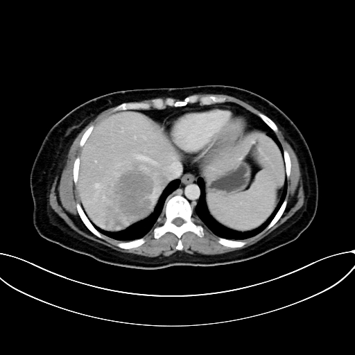 Adrenocortical carcinoma (Radiopaedia 87281-103569 Axial C+ portal venous phase 14).jpg