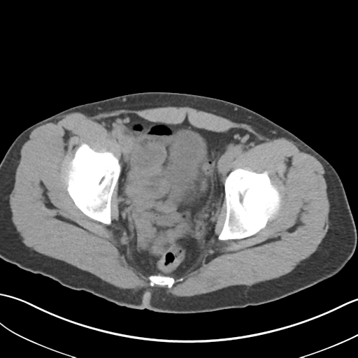 File:Adult polycystic kidney disease (Radiopaedia 47866-52626 Axial non-contrast 77).png