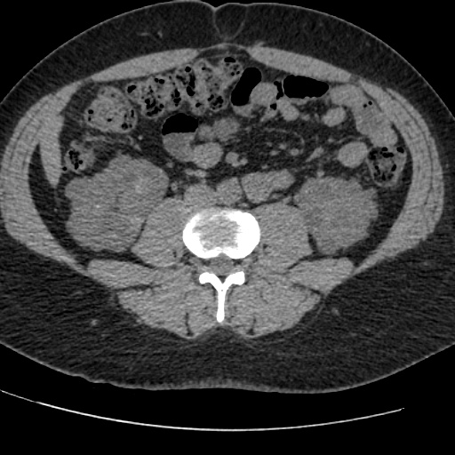 Adult polycystic kidney disease (Radiopaedia 59075-66368 Axial non-contrast 50).jpg
