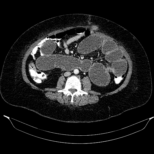Afferent loop syndrome - secondary to incarcerated trocar site hernia (Radiopaedia 82959-97305 Axial C+ portal venous phase 129).jpg