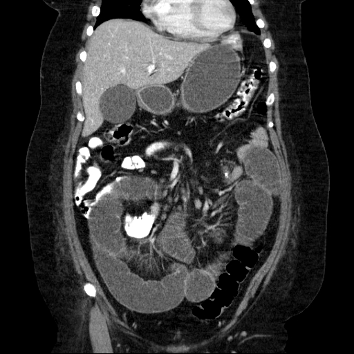 File:Afferent loop syndrome - secondary to incarcerated trocar site hernia (Radiopaedia 82959-97305 Coronal C+ portal venous phase 60).jpg