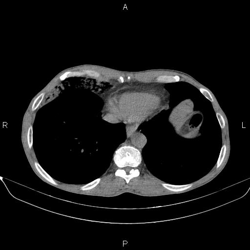 File:Air bronchogram in pneumonia (Radiopaedia 85719-101512 Axial non-contrast 53).jpg