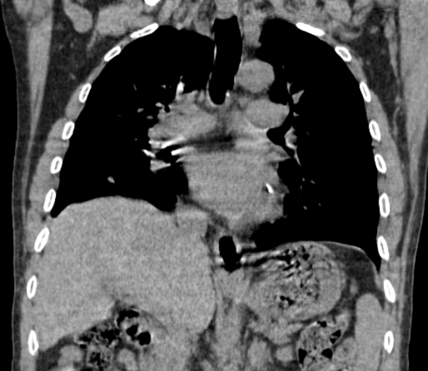 Airway foreign body in adult (Radiopaedia 85907-101779 Coronal liver window 138).jpg