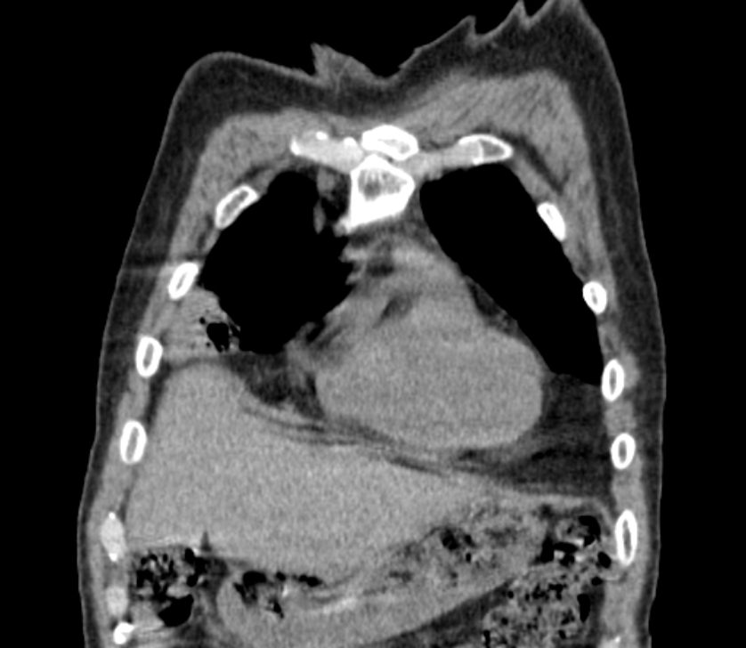Airway foreign body in adult (Radiopaedia 85907-101779 Coronal liver window 40).jpg