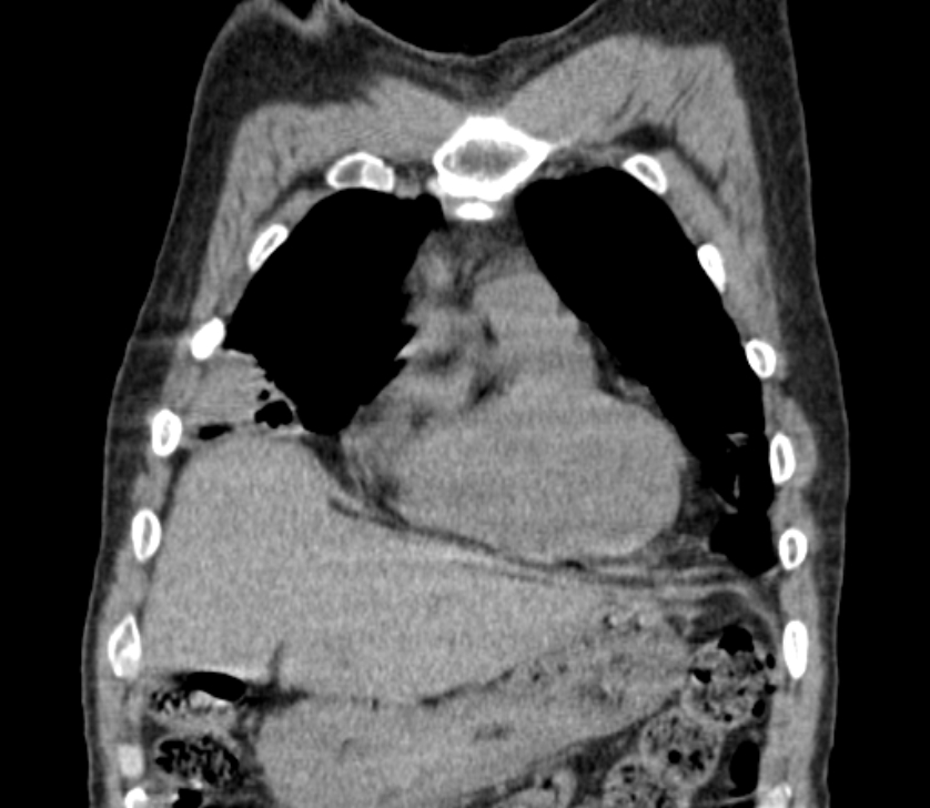 Airway foreign body in adult (Radiopaedia 85907-101779 Coronal liver window 52).jpg