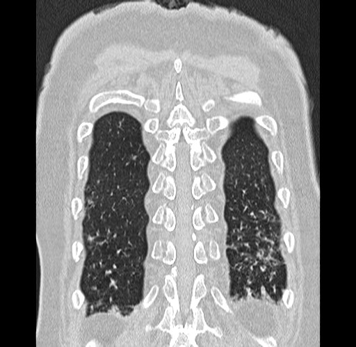 Alpha-1-antitrypsin deficiency (Radiopaedia 72058-82557 Coronal lung window 91).jpg