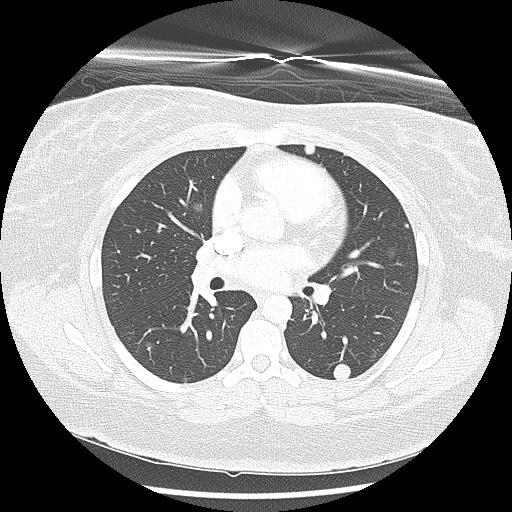 Alveolar soft part sarcoma - right leg (Radiopaedia 59432-67091 Axial lung window 54).jpg