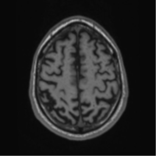 Alzheimer's disease- with Gerstmann syndrome and dressing apraxia (Radiopaedia 54882-61150 Axial T1 60).png