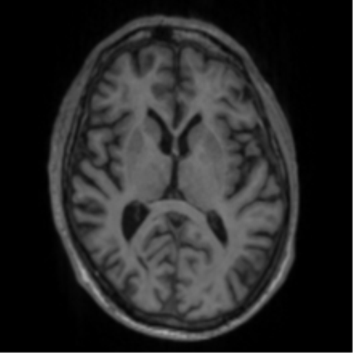 File:Alzheimer's disease- with apraxia (Radiopaedia 54763-61011 Axial T1 39).png