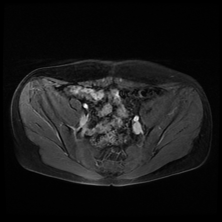 Ambiguous genitalia (Radiopaedia 69686-79643 Axial T1 C+ fat sat 14).jpg