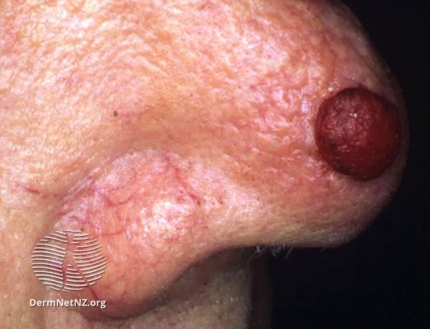 File:Amelanotic nodular melanoma (DermNet NZ lesions-mel2).jpg