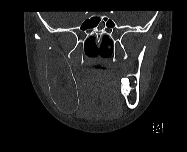 File:Ameloblastoma (Radiopaedia 26645-26793 bone window 11).jpg