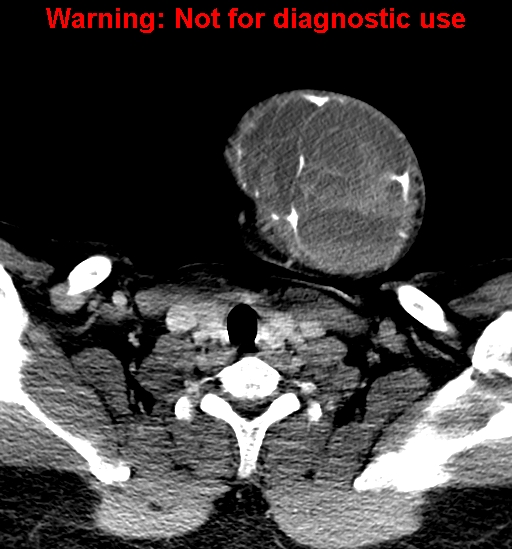 File:Ameloblastoma (Radiopaedia 33126-34164 B 35).jpg