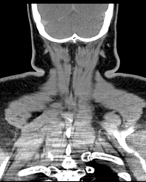 Ameloblastoma (Radiopaedia 38520-40623 Coronal non-contrast 67).png