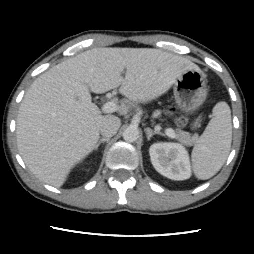 Amoebic liver abscesses (Radiopaedia 55536-62009 A 28).jpg