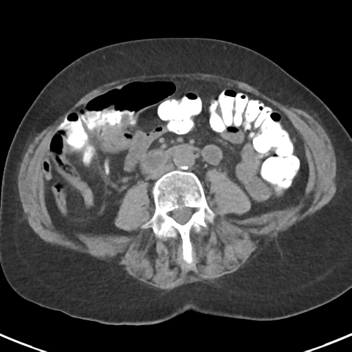 File:Ampullary adenocarcinoma (Radiopaedia 34013-35237 Axial non-contrast 35).png