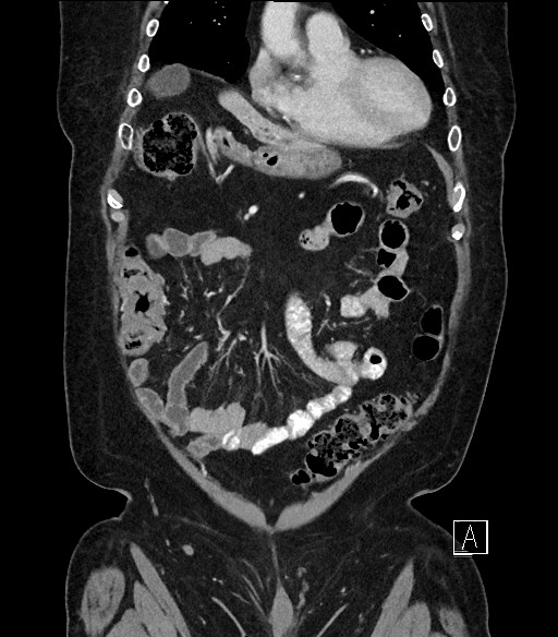 Ampullary adenocarcinoma (Radiopaedia 59373-66734 D 21).jpg