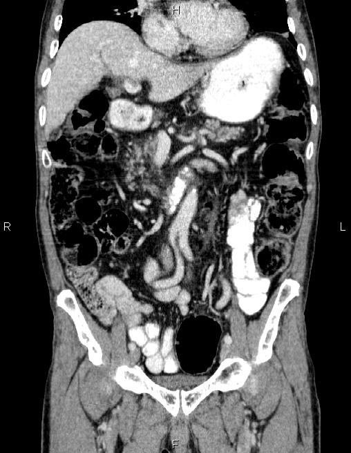 Ampullary adenocarcinoma (Radiopaedia 86093-102032 C 29).jpg