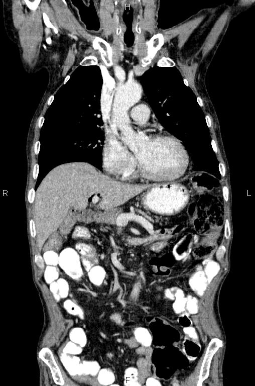 Ampullary adenocarcinoma (Radiopaedia 86093-102033 D 22).jpg