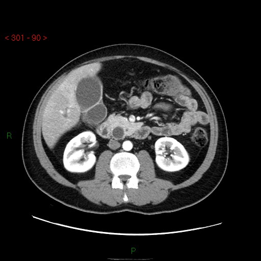 Ampullary carcinoma (Radiopaedia 56396-63056 B 36).jpg