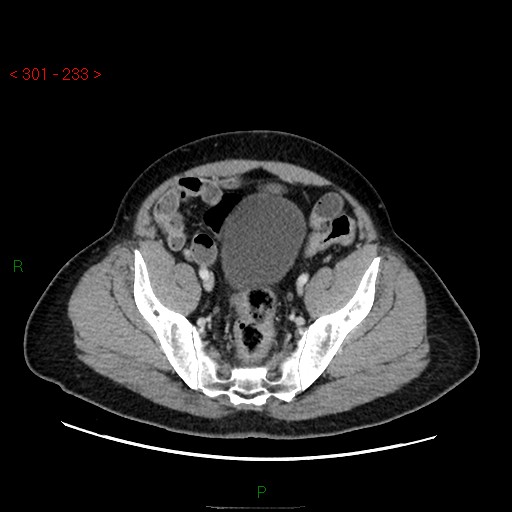 File:Ampullary carcinoma (Radiopaedia 56396-63056 C 83).jpg