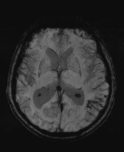 File:Amyloid angiopathy with inflammation (Radiopaedia 30360-31002 Axial SWI MIP 28).jpg
