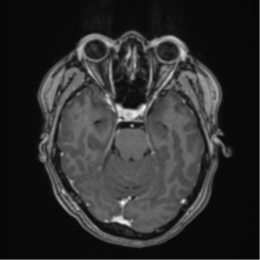 Anaplastic astroblastoma (Radiopaedia 55666-62194 Axial T1 C+ 26).png