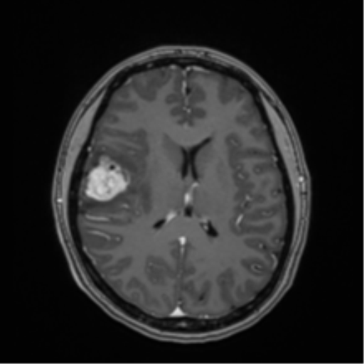 Anaplastic astroblastoma (Radiopaedia 55666-62194 Axial T1 C+ 44).png