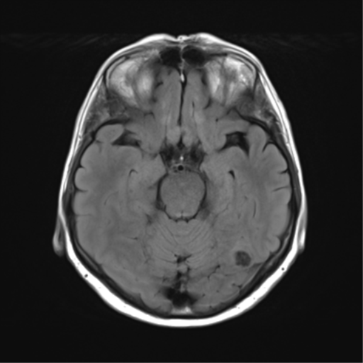 File:Anaplastic astrocytoma (Radiopaedia 86943-103160 Axial FLAIR 11).png