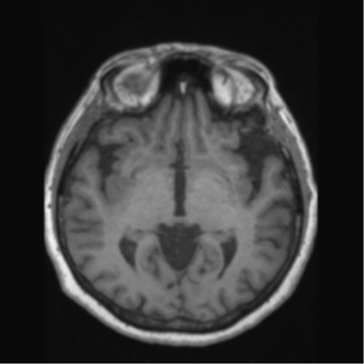 Anaplastic astrocytoma IDH wild-type (pseudoprogression) (Radiopaedia 42209-45276 Axial T1 73).png