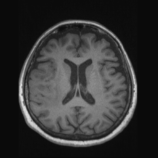 Anaplastic astrocytoma IDH wild-type (pseudoprogression) (Radiopaedia 42209-45276 Axial T1 91).png