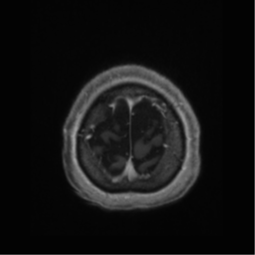 Anaplastic astrocytoma IDH wild-type (pseudoprogression) (Radiopaedia 42209-45277 Axial T1 C+ 120).png