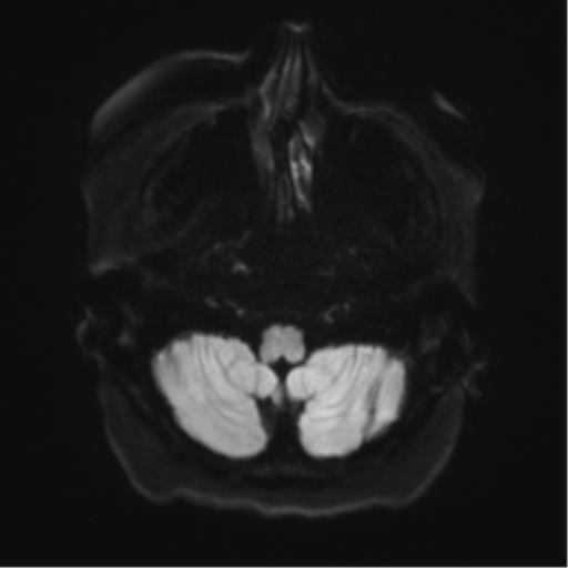 Anaplastic astrocytoma IDH wild-type (pseudoprogression) (Radiopaedia 42209-45279 Axial DWI 31).png