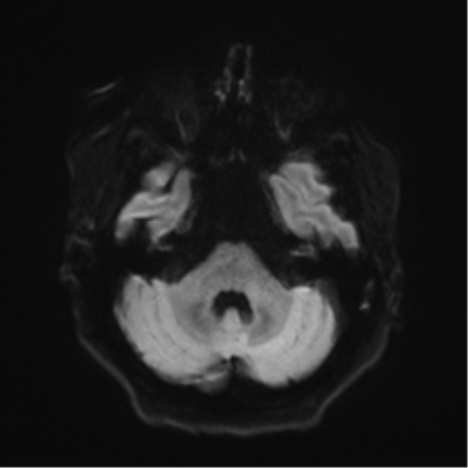 Anaplastic astrocytoma IDH wild-type (pseudoprogression) (Radiopaedia 42209-45279 Axial DWI 34).png