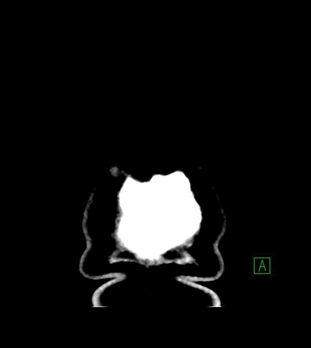 Anaplastic oligodendroglioma (Radiopaedia 79571-92758 Coronal non-contrast 67).jpg