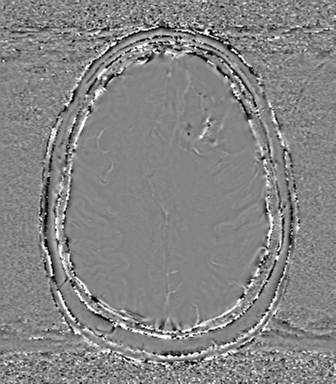 Anaplastic oligodendroglioma (Radiopaedia 83500-98599 Axial SWI - phase 61).png