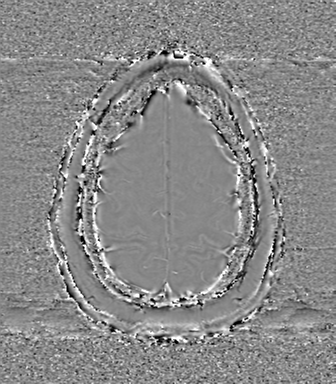 Anaplastic oligodendroglioma (Radiopaedia 83500-98599 Axial SWI - phase 74).png