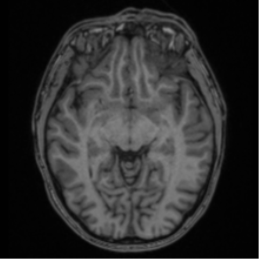 Anaplastic oligodendroglioma with skull fracture (Radiopaedia 74831-85845 Axial T1 27).png