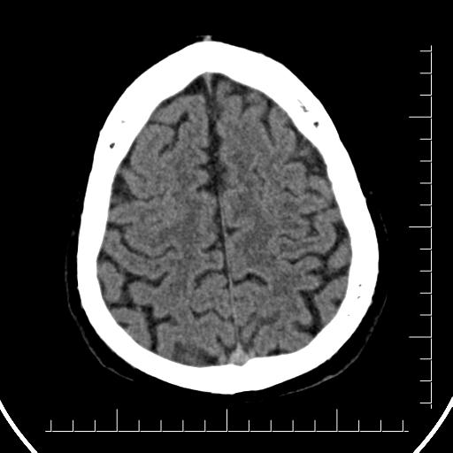 Aneurysm of posterior communicating artery (Radiopaedia 20188-20162 Axial non-contrast 39).jpg