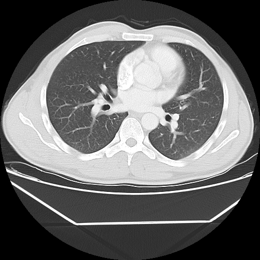 File:Aneurysmal bone cyst - rib (Radiopaedia 82167-96220 Axial lung window 37).jpg