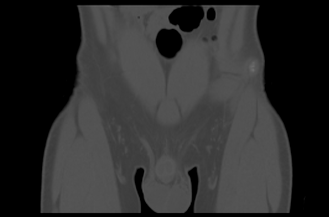 File:Aneurysmal bone cyst of ischium (Radiopaedia 25957-26094 Coronal bone window 1).png
