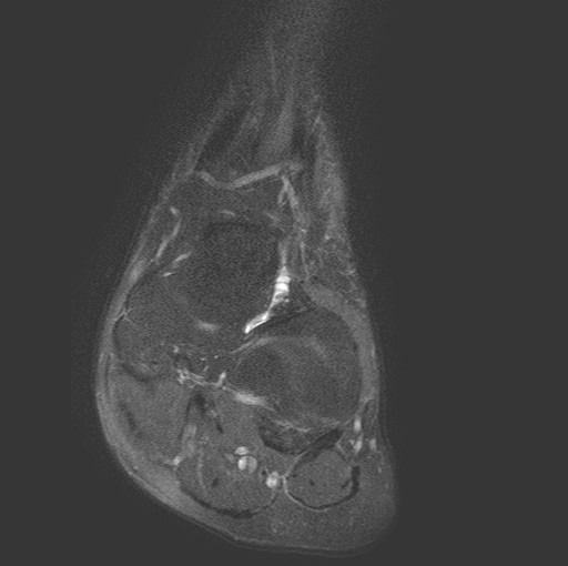 File:Aneurysmal bone cyst of the calcaneus (Radiopaedia 60669-68420 Coronal T2 fat sat 1).jpg