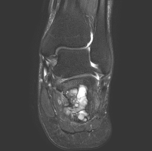 File:Aneurysmal bone cyst of the calcaneus (Radiopaedia 60669-68420 Coronal T2 fat sat 12).jpg